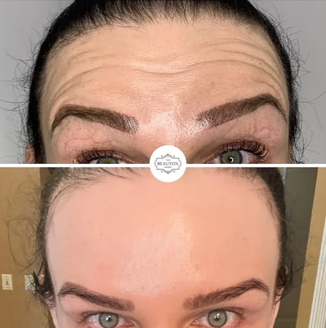 Botox & Dysport before and after result