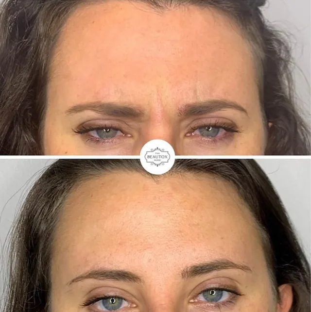 Botox & Dysport before and after result