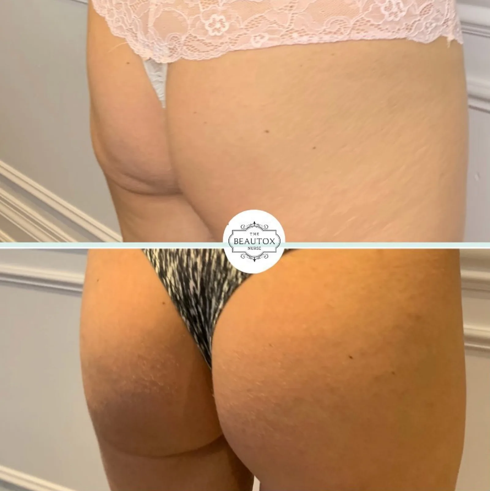 Non-surgical Butt Lift before and after result