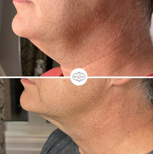 Fat Loss Injections before and after result