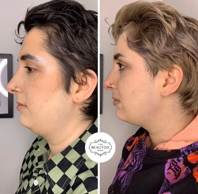Fat Loss Injections before and after result