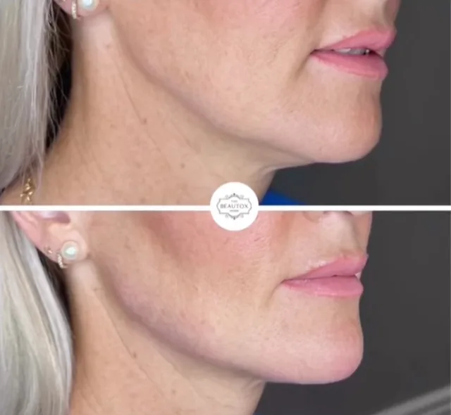 Dermal & Biostimulator Fillers before and after result