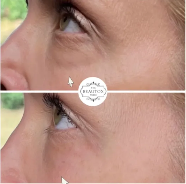 Dermal & Biostimulator Fillers before and after result