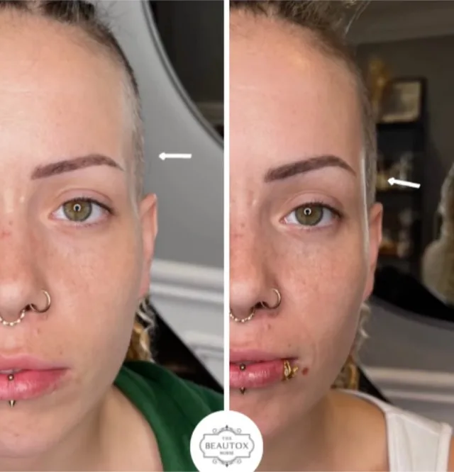 Dermal & Biostimulator Fillers before and after result