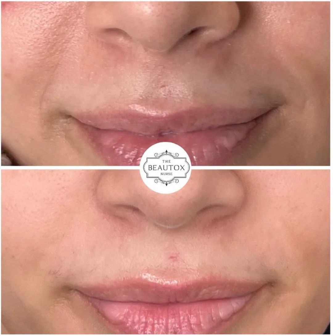PRP & PRF Treatments before and after result