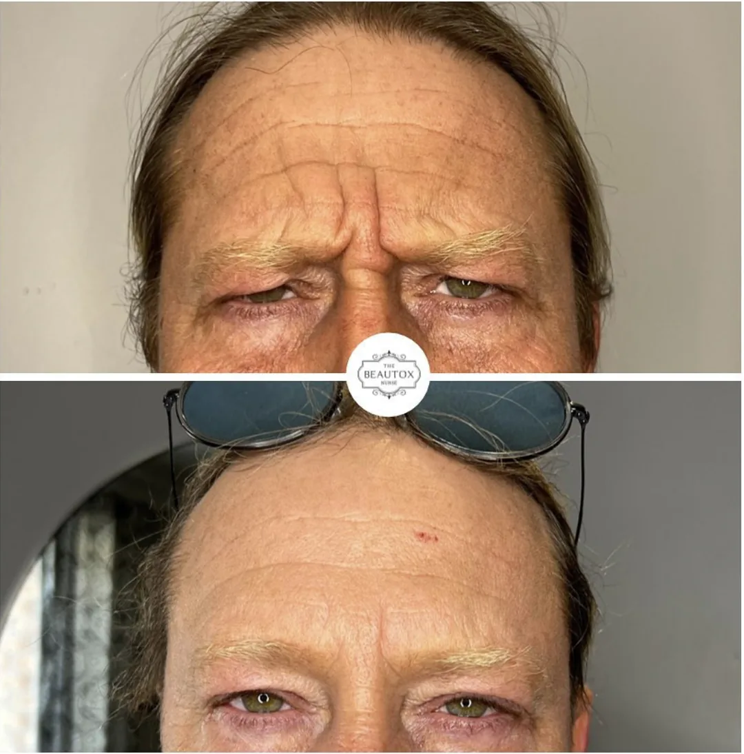 Botox & Dysport