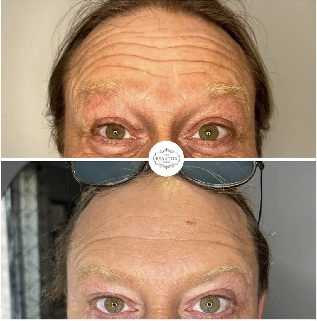 Botox & Dysport