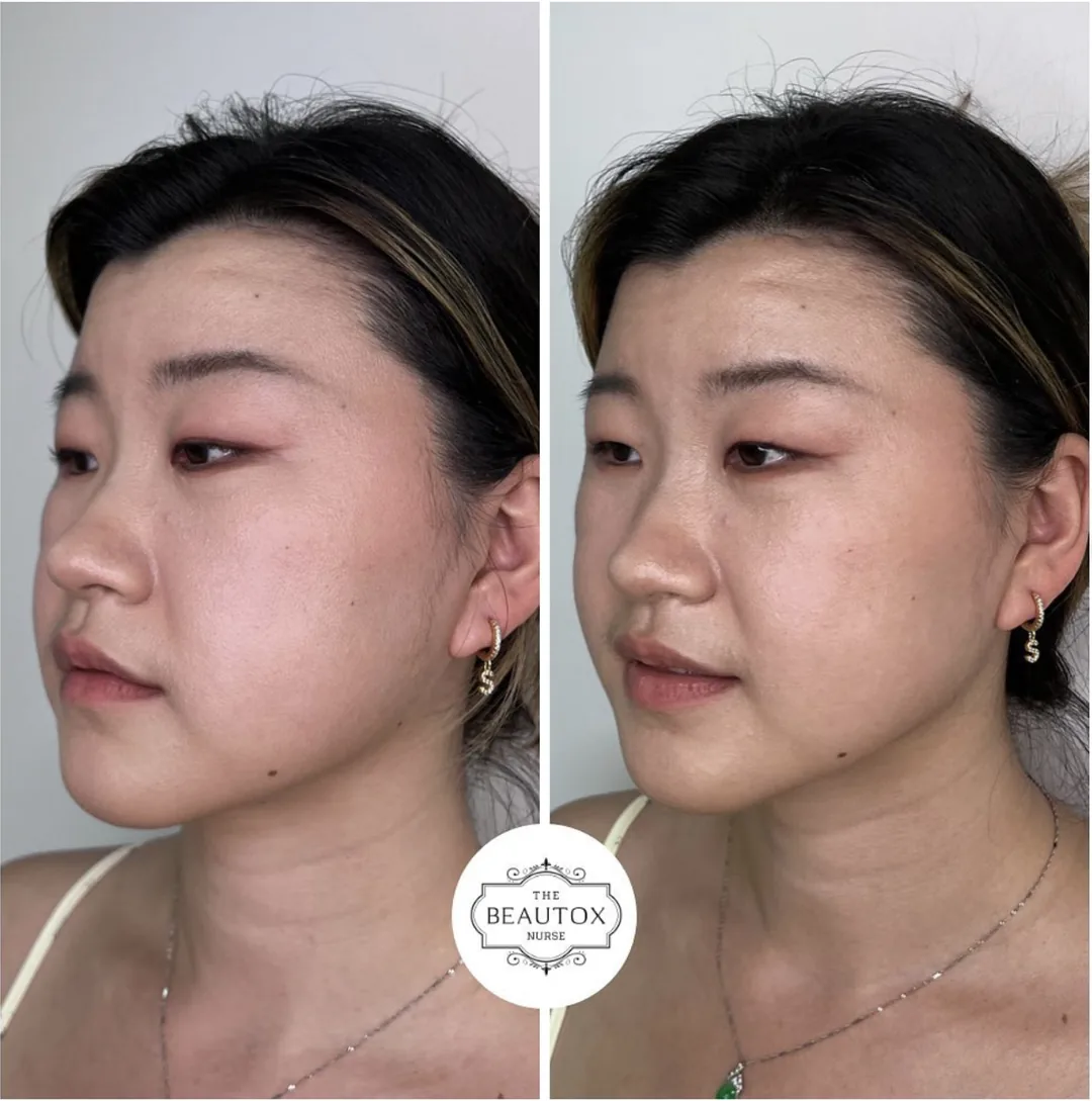 Dermal & Biostimulator Fillers