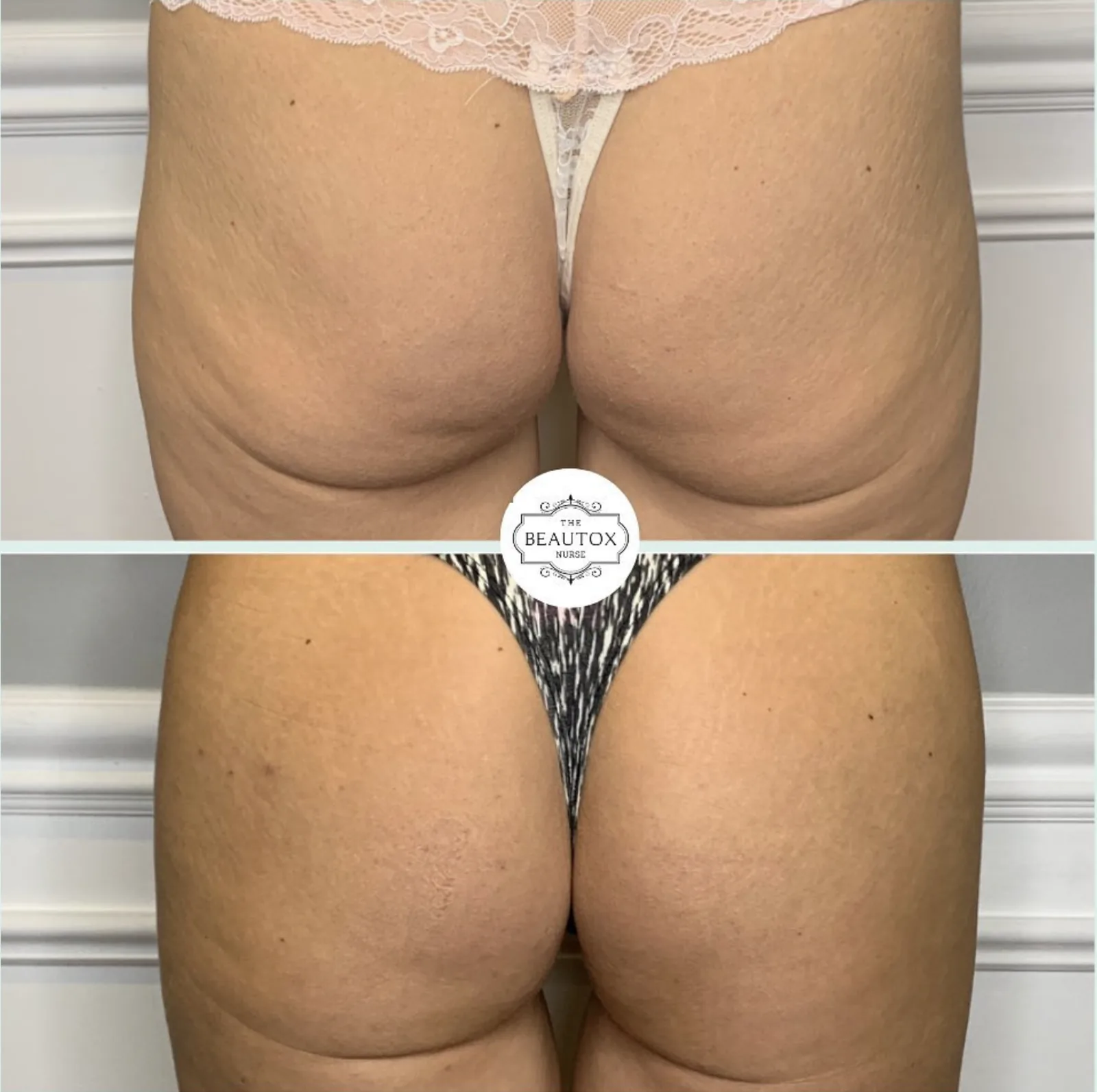Non-surgical Butt Lift